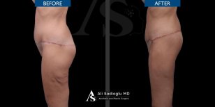 Before and after thigh lift results at Dr. Safa Manav Clinic, improved thigh contour visible