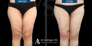 Before and after thigh lift results at Dr. Safa Manav Clinic, improved leg contour visible