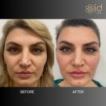 Before and after thread lifting results at ID Clinic Bangkok, visible facial contour improvement