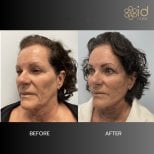 Before and after threads lifting results at ID Clinic Bangkok, facial rejuvenation procedure