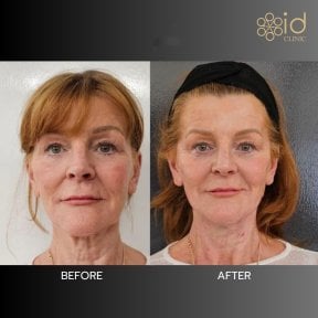 Before and after threads lifting result at ID Clinic Bangkok, visible facial rejuvenation