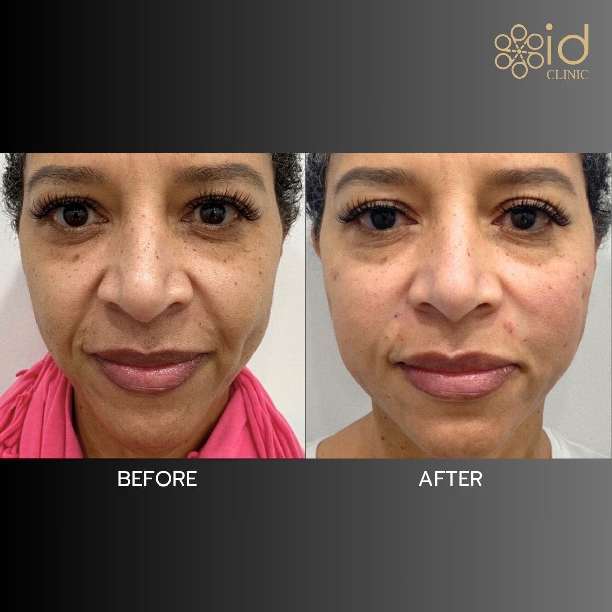 Resultados antes y después de lifting con hilos en ID Clinic Bangkok, tensado facial