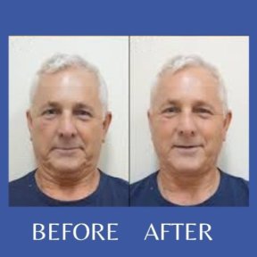 Before and after mini facelift results at ID Clinic Bangkok, visible facial rejuvenation