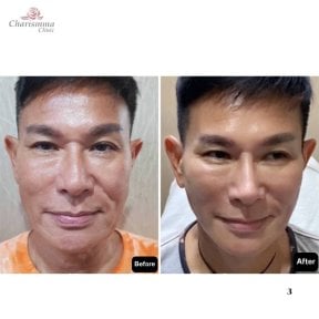 Before and after neck lift results at Charismma Clinic, visible facial rejuvenation