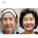 Результати до і після підтяжки обличчя в Charismma Clinic, помітне омолодження