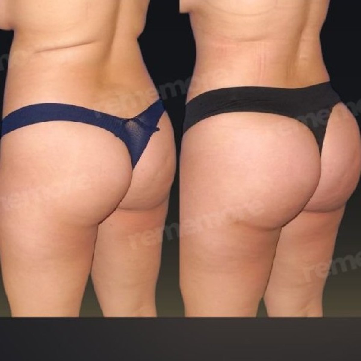 Antes y después de implantes de glúteos en Memorial Göztepe Hospital – contorno mejorado