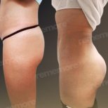 Vorher-nachher-Ergebnis Gesäßimplantate bei Memorial Göztepe Hospital, verbesserte Kontur
