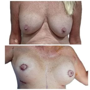 Before and after breast lift results at Hospital de la Familia, improved breast contour visible