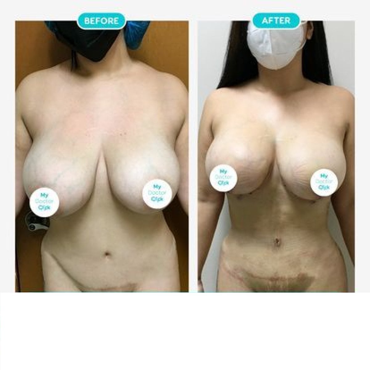 Before and after breast lift results at Hospital de la Familia, improved breast contour