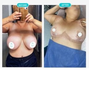 Before and after breast lift results at Hospital de la Familia, improved breast contour visible