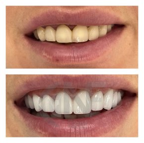 Before and after Lumineer veneers result at Nifa Dent International – brighter, even smile