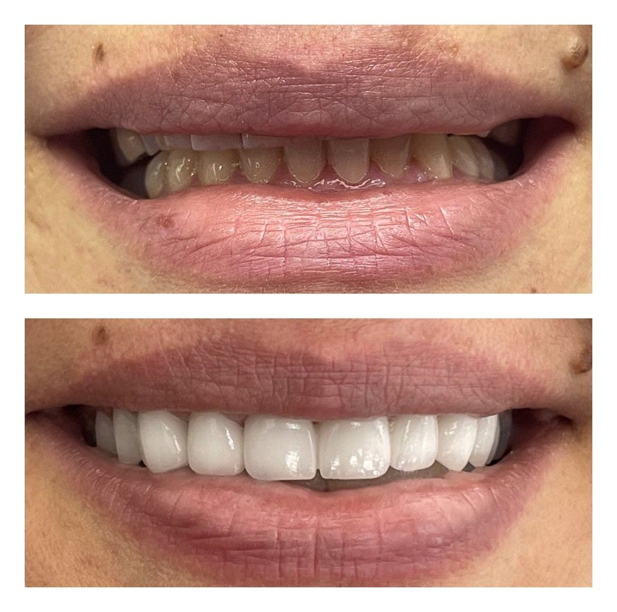 Resultados antes y después de Lumineers en Nifa Dent International – transformación de sonrisa