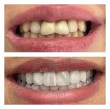 Before and after Lumineer results at Nifa Dent International – smile transformation with veneers
