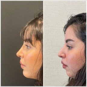 Результати до і після імплантації підборіддя в Op. Dr. Sinan Eroglu Clinic, покращений профіль