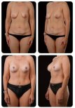 نتائج شد البطن وتكبير الثدي قبل وبعد في Yurchenko Plastic Surgery Kyiv