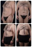 نتائج شد البطن قبل وبعد في Yurchenko Plastic Surgery Team Kyiv، تحسن البطن