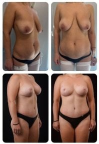نتائج شد البطن قبل وبعد في Yurchenko Plastic Surgery Team Kyiv، بطن مسطح