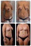 نتائج شد البطن قبل وبعد في Yurchenko Plastic Surgery Team Kyiv، بطن مسطح
