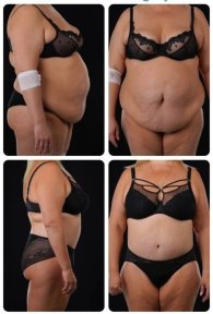 نتائج شد البطن قبل وبعد في Yurchenko Plastic Surgery Team Kyiv، تحسين شكل البطن
