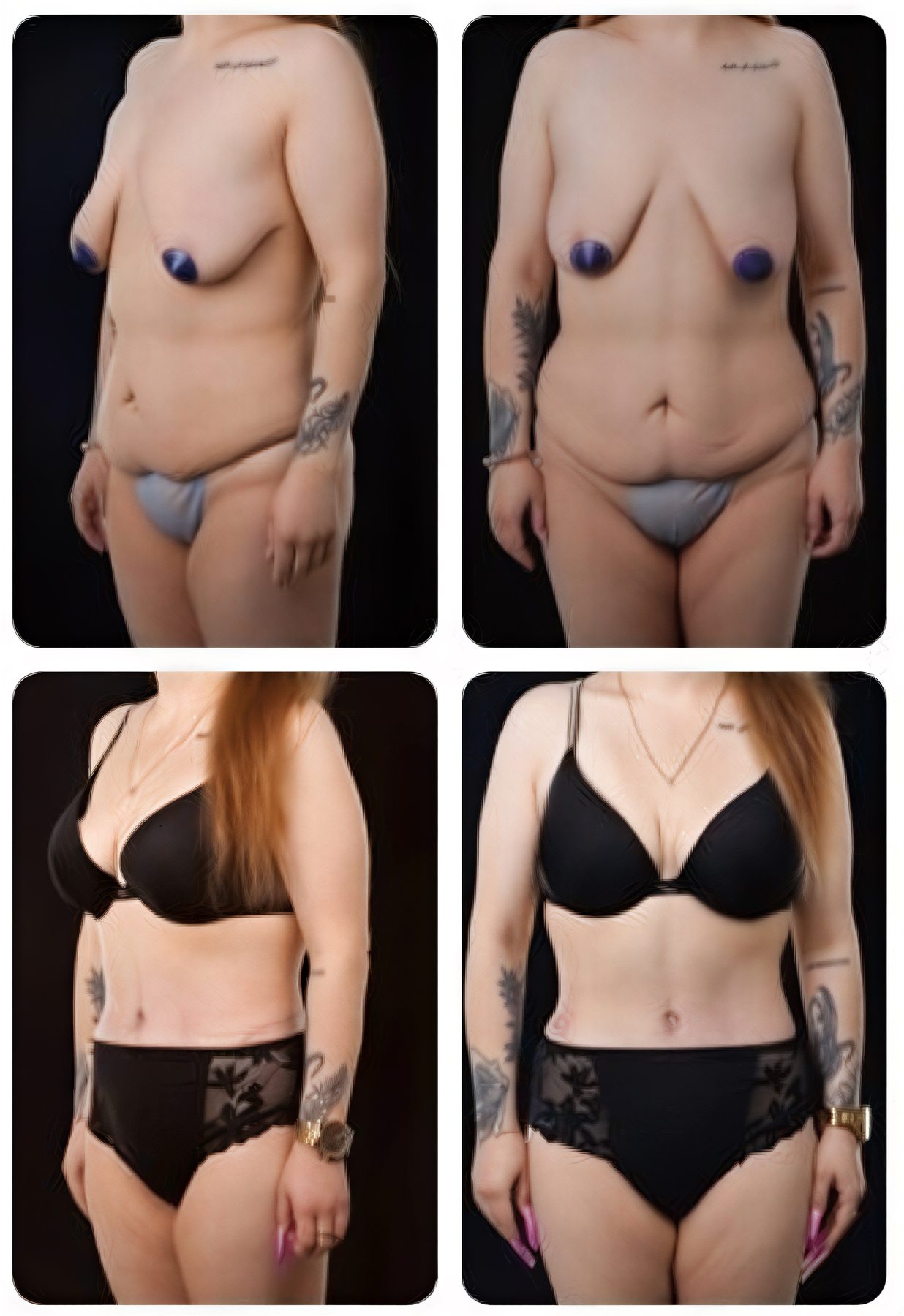 نتائج شد البطن قبل وبعد في Yurchenko Plastic Surgery Team Kyiv، تحسين شكل الجسم