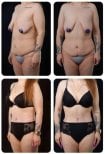 نتائج شد البطن قبل وبعد في Yurchenko Plastic Surgery Team Kyiv، تحسين شكل الجسم