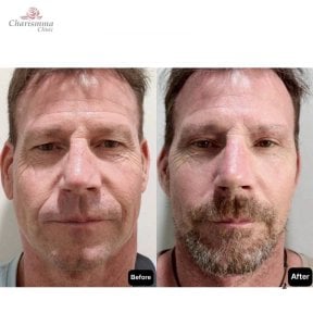 Facelift before and after results at Charismma Clinic, visible facial rejuvenation in male patient