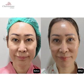 Результати до і після підтяжки обличчя в Charismma Clinic, помітне омолодження та ліфтинг