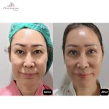 Результати до і після підтяжки обличчя в Charismma Clinic, помітне омолодження та ліфтинг