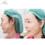 Before and after deep plane facelift results at Charismma Clinic, visible facial rejuvenation