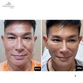 Before and after deep plane facelift results at Charismma Clinic, facial rejuvenation visible