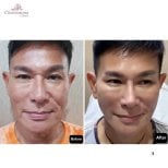 Before and after deep plane facelift results at Charismma Clinic, facial rejuvenation visible
