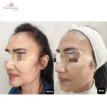 Before and after deep plane facelift results at Charismma Clinic, visible facial rejuvenation