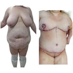 Mommy makeover before and after results at Hospital de la Familia, body contouring transformation