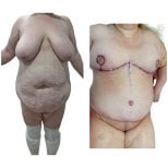 Mommy makeover before and after results at Hospital de la Familia, body contouring transformation