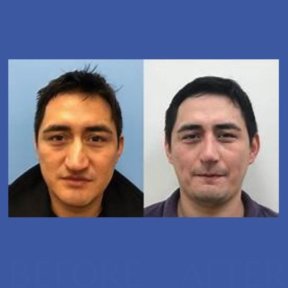 Before and after rhinoplasty results at ID Clinic Bangkok, nose reshaping for improved profile