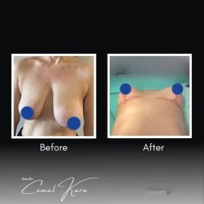 Vorher-nachher-Ergebnisse Bruststraffung bei Assoc.Prof.Dr.Cemal Kara / Medical Park İzmir Hospital