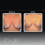 Vorher-nachher-Ergebnis Brustverkleinerung bei Assoc.Prof.Dr.Cemal Kara / Medical Park İzmir
