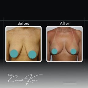 Vorher-nachher-Ergebnis Bruststraffung bei Assoc.Prof.Dr.Cemal Kara / Medical Park İzmir