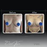 Resultados de aumento de senos antes y después en Assoc.Prof.Dr.Cemal Kara / Medical Park İzmir