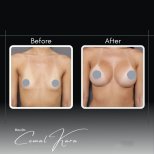 Resultados antes y después de aumento de senos en Assoc.Prof.Dr.Cemal Kara / Medical Park İzmir