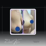 Vorher-nachher-Ergebnisse Bruststraffung bei Assoc.Prof.Dr.Cemal Kara / Medical Park İzmir Hospital