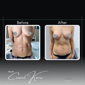 Before and after breast augmentation results at Assoc.Prof.Dr.Cemal Kara / Medical Park İzmir Hospital