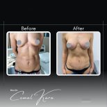 Before and after breast augmentation results at Assoc.Prof.Dr.Cemal Kara / Medical Park İzmir Hospital