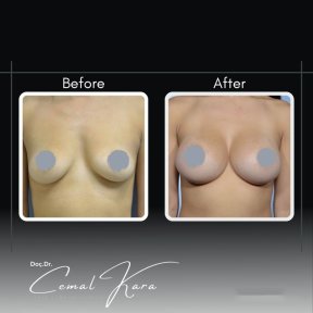 Resultados antes y después de aumento de senos en Assoc.Prof.Dr.Cemal Kara / Medical Park İzmir