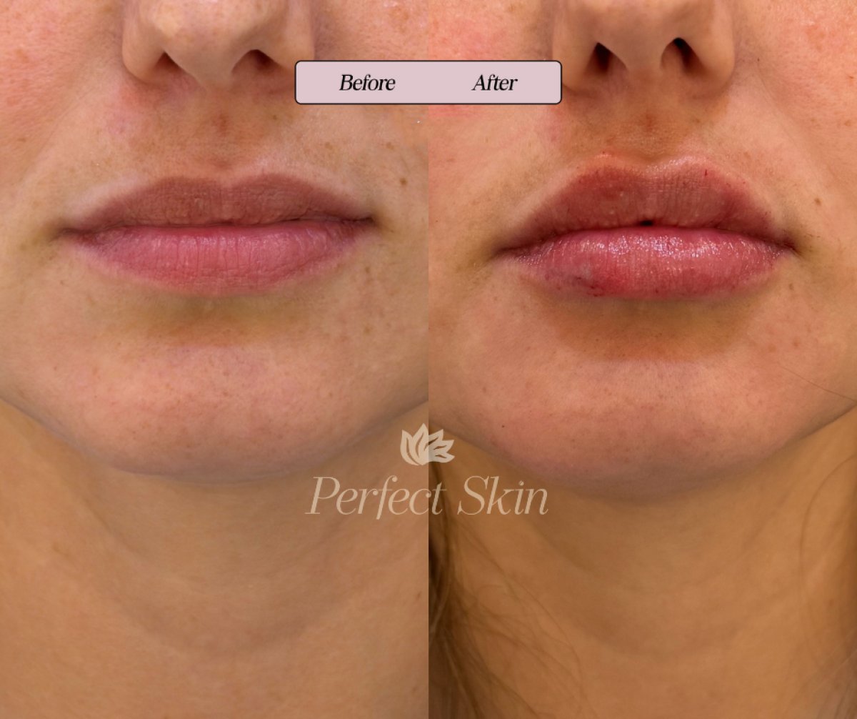 نتيجة شد الخيوط بحمض الهيالورونيك قبل وبعد في Perfect Skin، زيادة حجم الشفاه