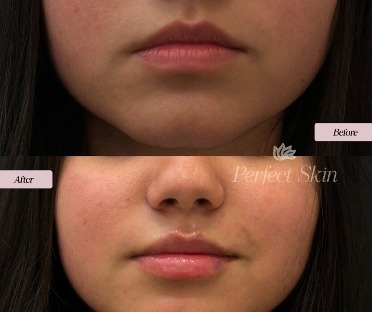 Resultados antes y después de hilos de ácido hialurónico en Perfect Skin, labios mejorados