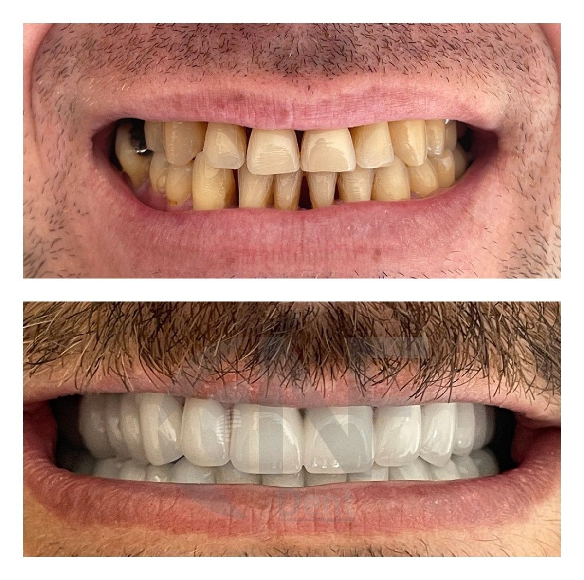 قبل وبعد قشور الزركونيا في Nifa Dent International، نتائج تجميل الابتسامة