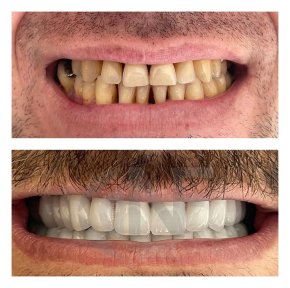 Before and after zirconia veneers at Nifa Dent International, smile makeover results