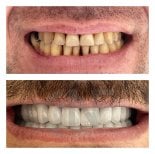 Before and after zirconia veneers at Nifa Dent International, smile makeover results