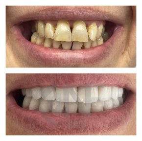 Before and after zirconia veneers results at Nifa Dent International – smile makeover